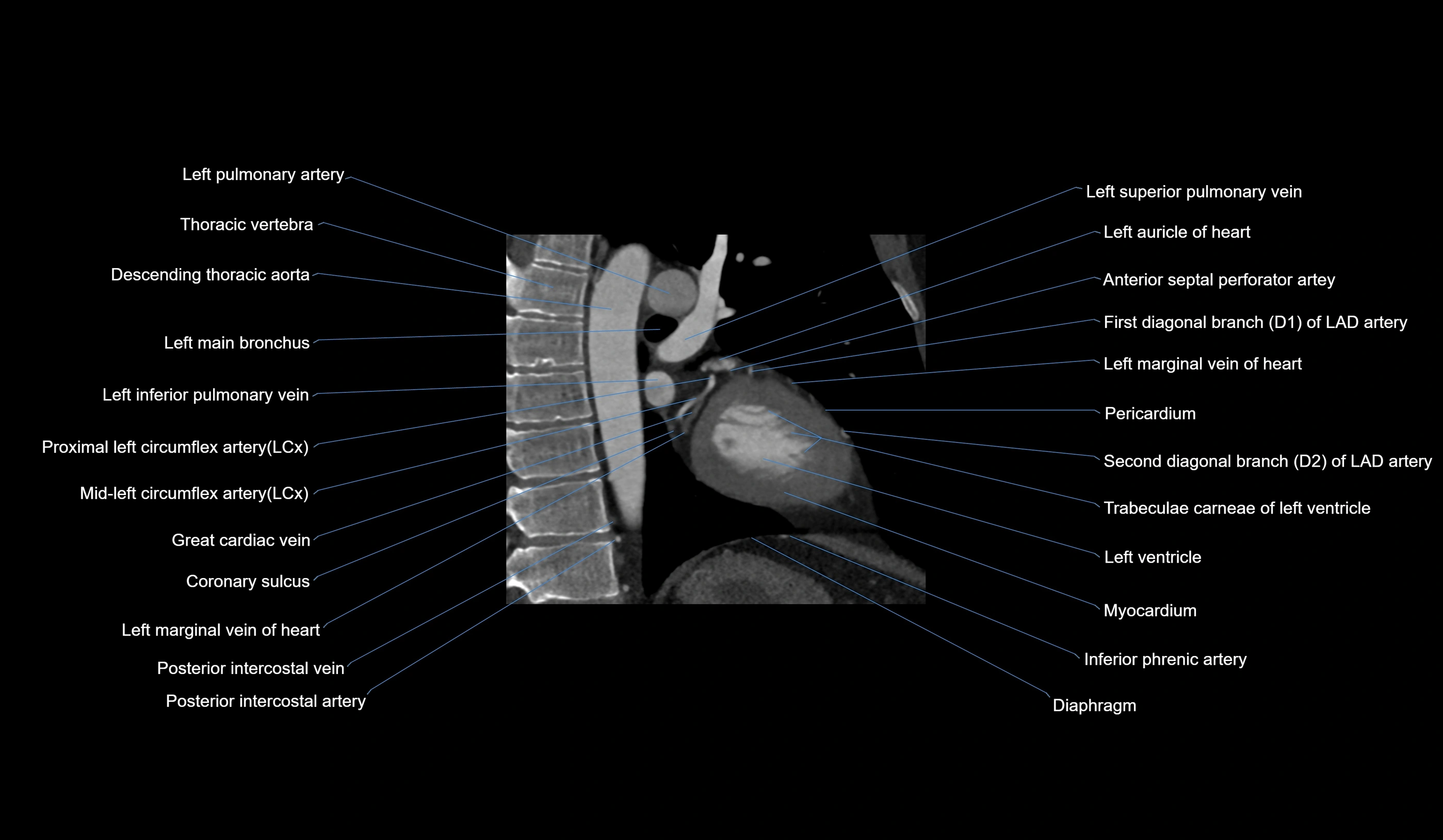 CT heart (coronary angiogram) 2 chamber view cross sectional anatomy labelled radiology image-00007.webp